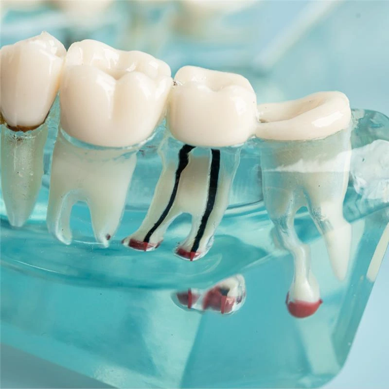 Decoding Cavities & Root Canal Infections
