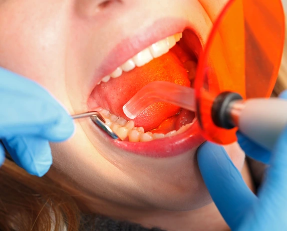 Dental Bonding Flower Mound