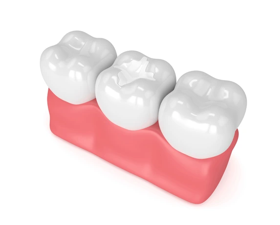 Dental Filling Flower Mound