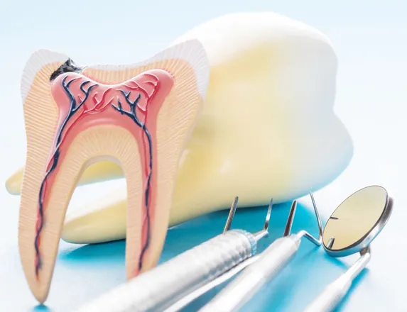 Root Canal Treatment in Flower Mound