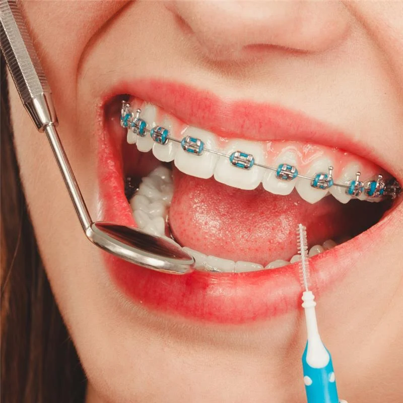 Do I Need Teeth Cleaning Before Getting Braces?