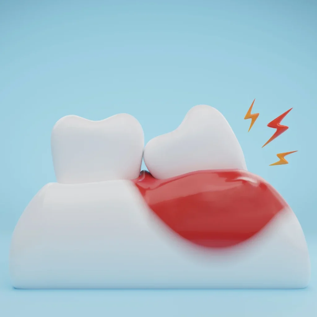 Signs Your Wisdom Teeth Need to Come Out: Symptoms to Watch 