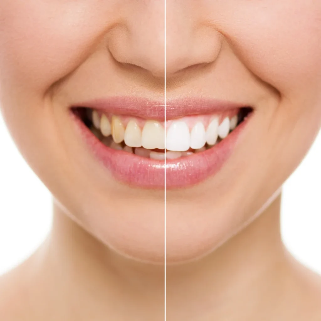 Teeth Whitening Before and After results showing a bright white smile