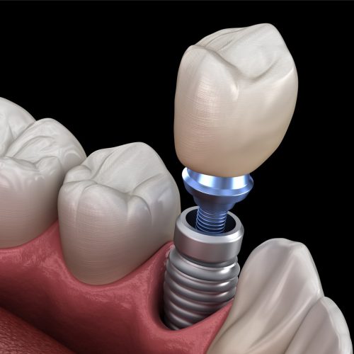 Who-is-a-Good-Candidate-for-Dental-Implants_img